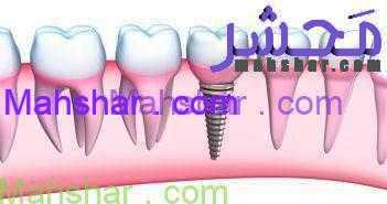 bigstock Dental Implant detailed view 39564646small 1030x571 12 ایمپلنت دندانی چیست؟