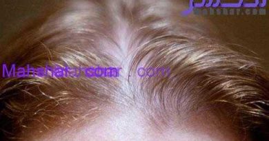 women hairloss 2 دلایل ریزش مو در زنان