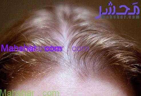 women hairloss 156 دلایل ریزش مو در زنان